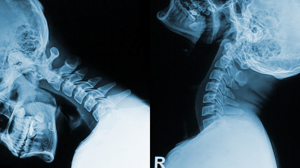 What CRMA Is - xray image